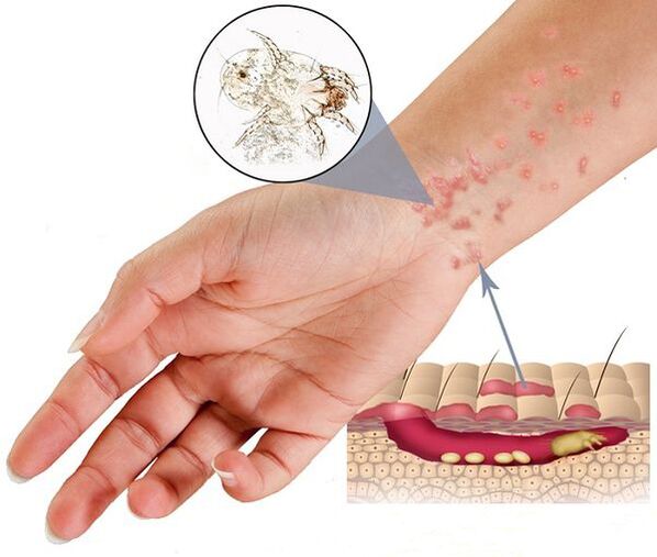 The scabies mite drills under the skin